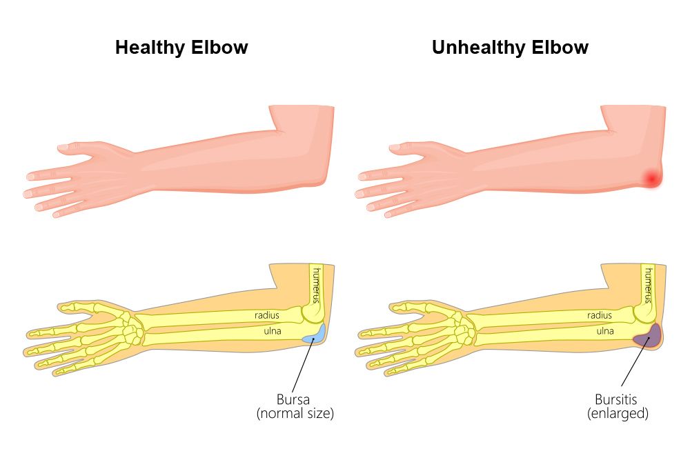 An image depicting elbow bursitis