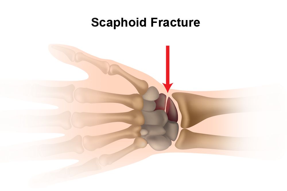 An arrow pointing to the scaphoid bone