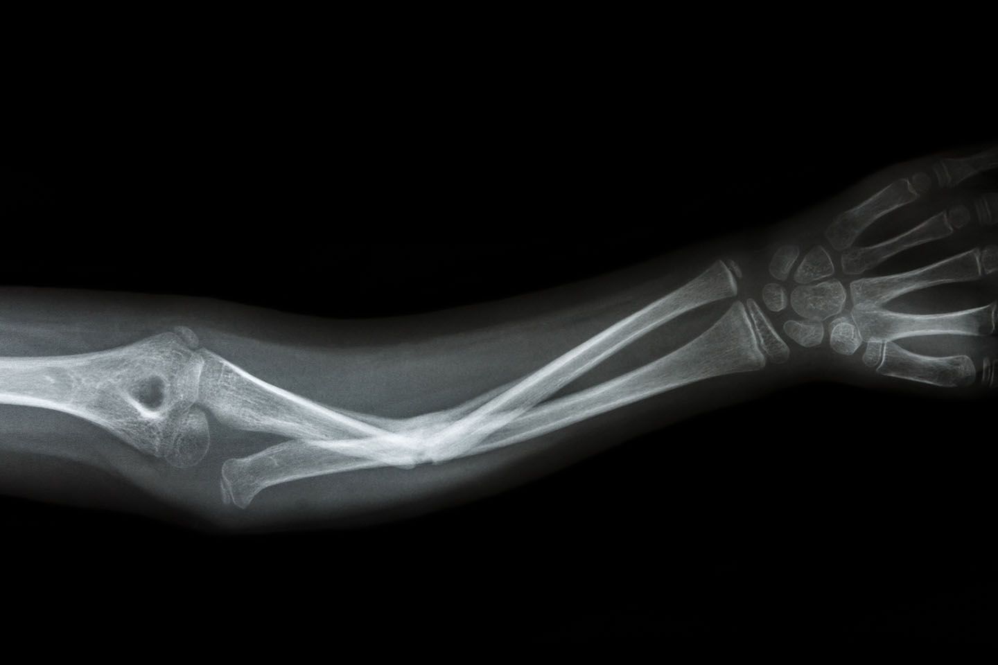 X-ray of a broken ulna.