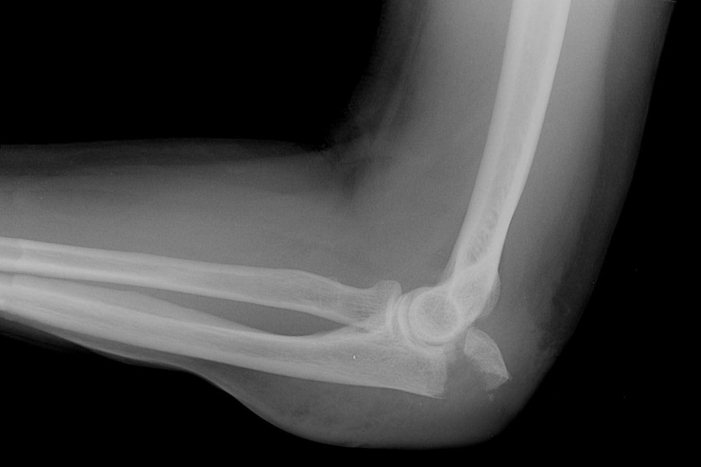 X-ray of an arm with an olecranon fracture.